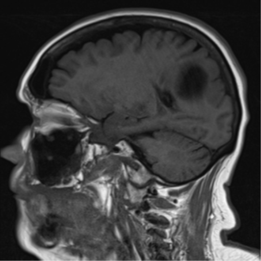 File:Gliomatosis, multifocal glioma (Radiopaedia 50663-56094 Sagittal 9 ...