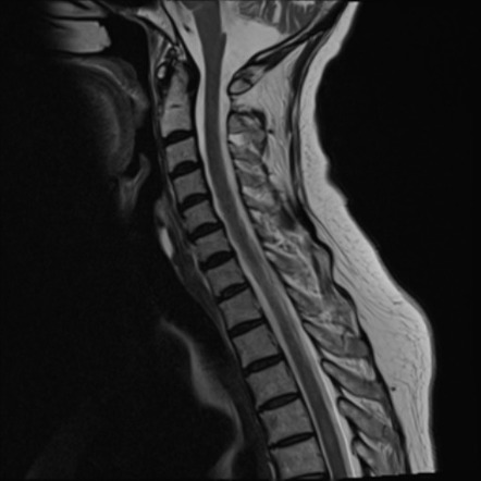 Leptomeningeal carcinomatosis (extensive) | Radiology Case ...