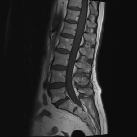 Leptomeningeal carcinomatosis (extensive) | Image | Radiopaedia.org