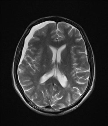 Subdural hygroma | Radiology Reference Article | Radiopaedia.org