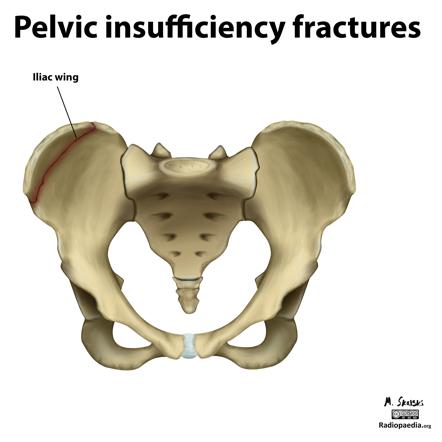 Pelvic Insufficiency Fractures (illustrations) | Image | Radiopaedia.org