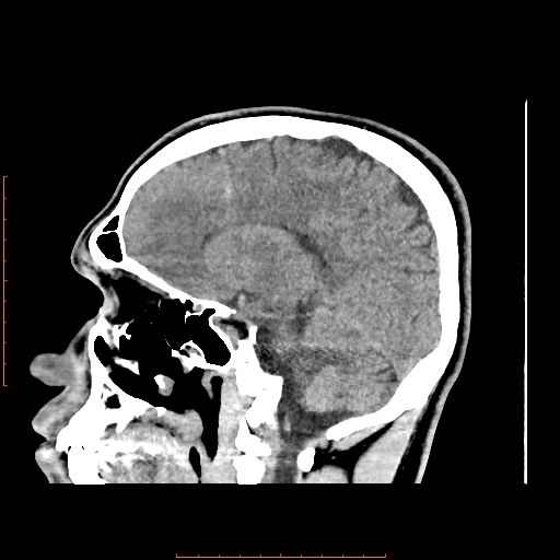 Developmental venous anomaly | Image | Radiopaedia.org