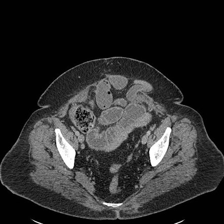 Closed loop small bowel obstruction | Radiology Case | Radiopaedia.org