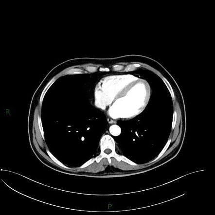 Rectal cancer with metastases | Image | Radiopaedia.org