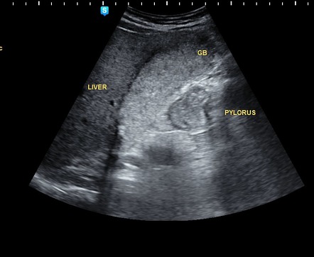 Hepatisation of the gallbladder | Radiology Reference Article ...