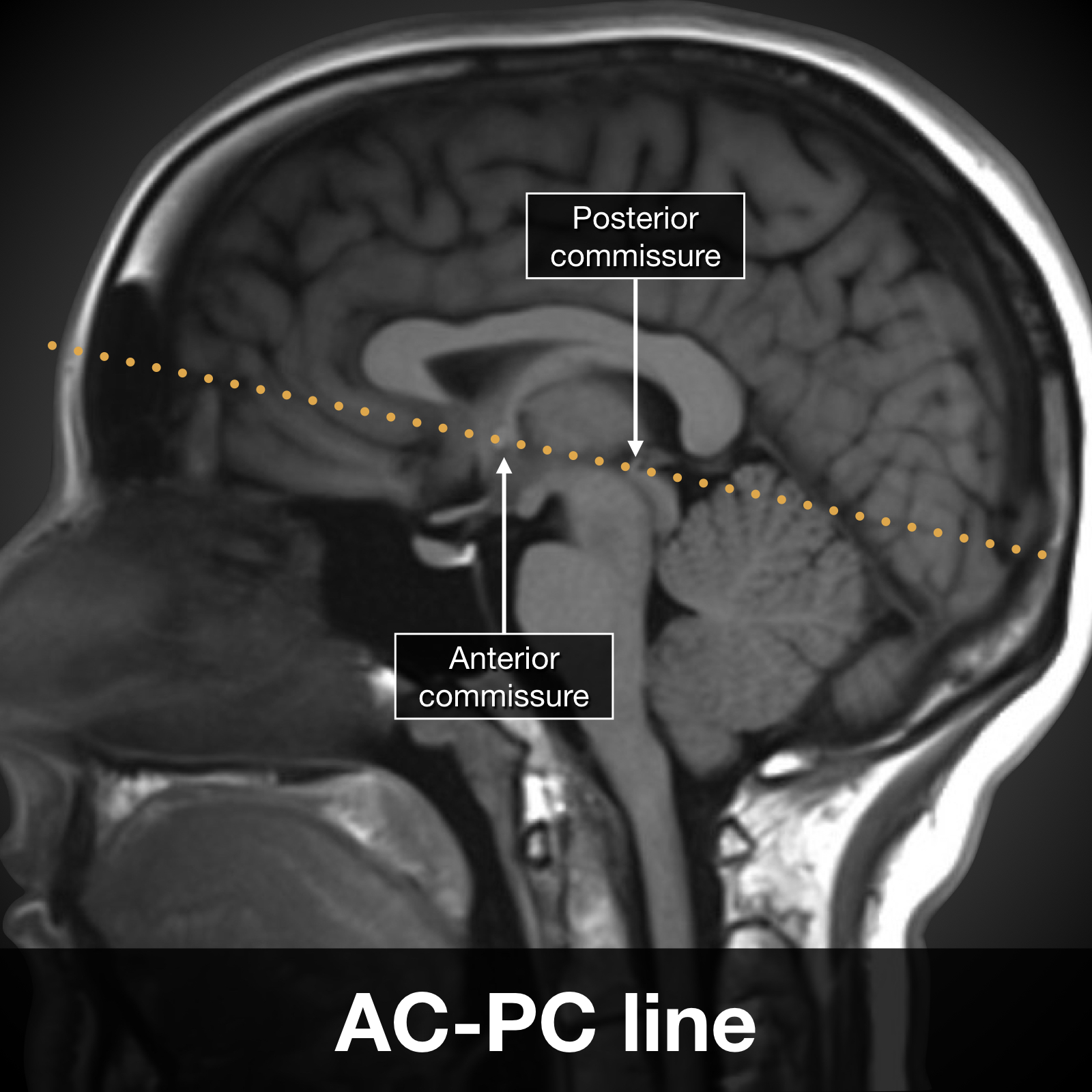 AC-PC line (diagram) | Image | Radiopaedia.org