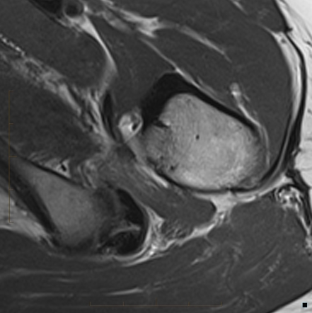 Chronic ischio-femoral impingement | Radiology Case | Radiopaedia.org