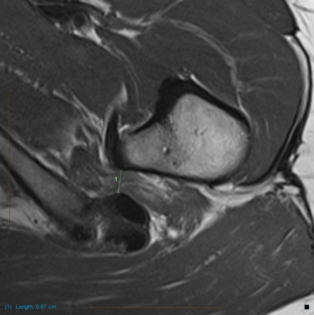 Ischiofemoral impingement | Radiology Reference Article | Radiopaedia.org