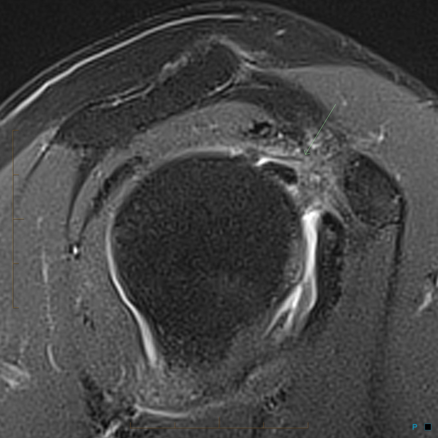 Adhesive capsulitis shoulder Image