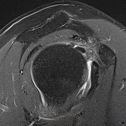 Adhesive capsulitis - shoulder | Image | Radiopaedia.org