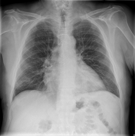 Left lower lobe pneumonia | Radiology Case | Radiopaedia.org