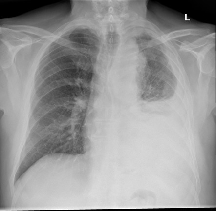 Pleural Tumor And Effusion Radiology Case Radiopaedia Org