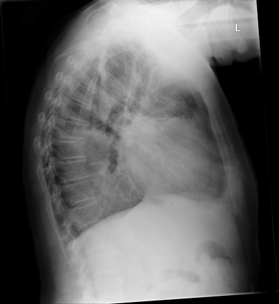 Pleural tumor and effusion | Radiology Case | Radiopaedia.org