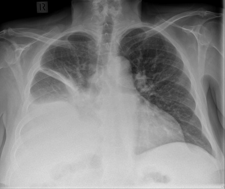 Subpulmonic effusion | Radiology Case | Radiopaedia.org