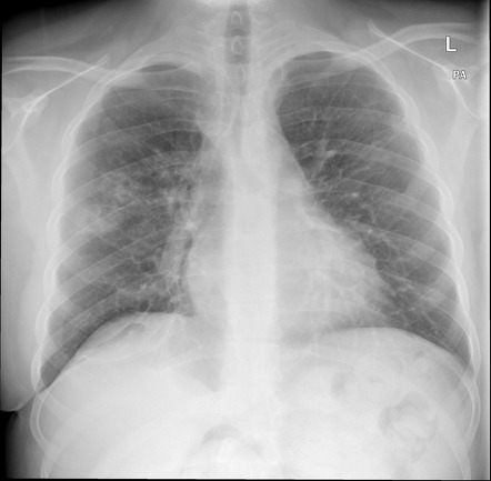 Right upper lobe infective changes | Radiology Case | Radiopaedia.org