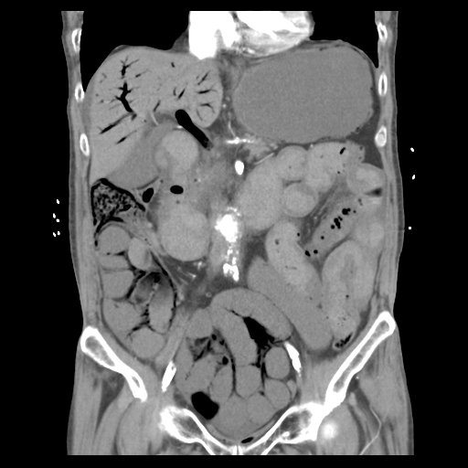 Small bowel infarction | Image | Radiopaedia.org