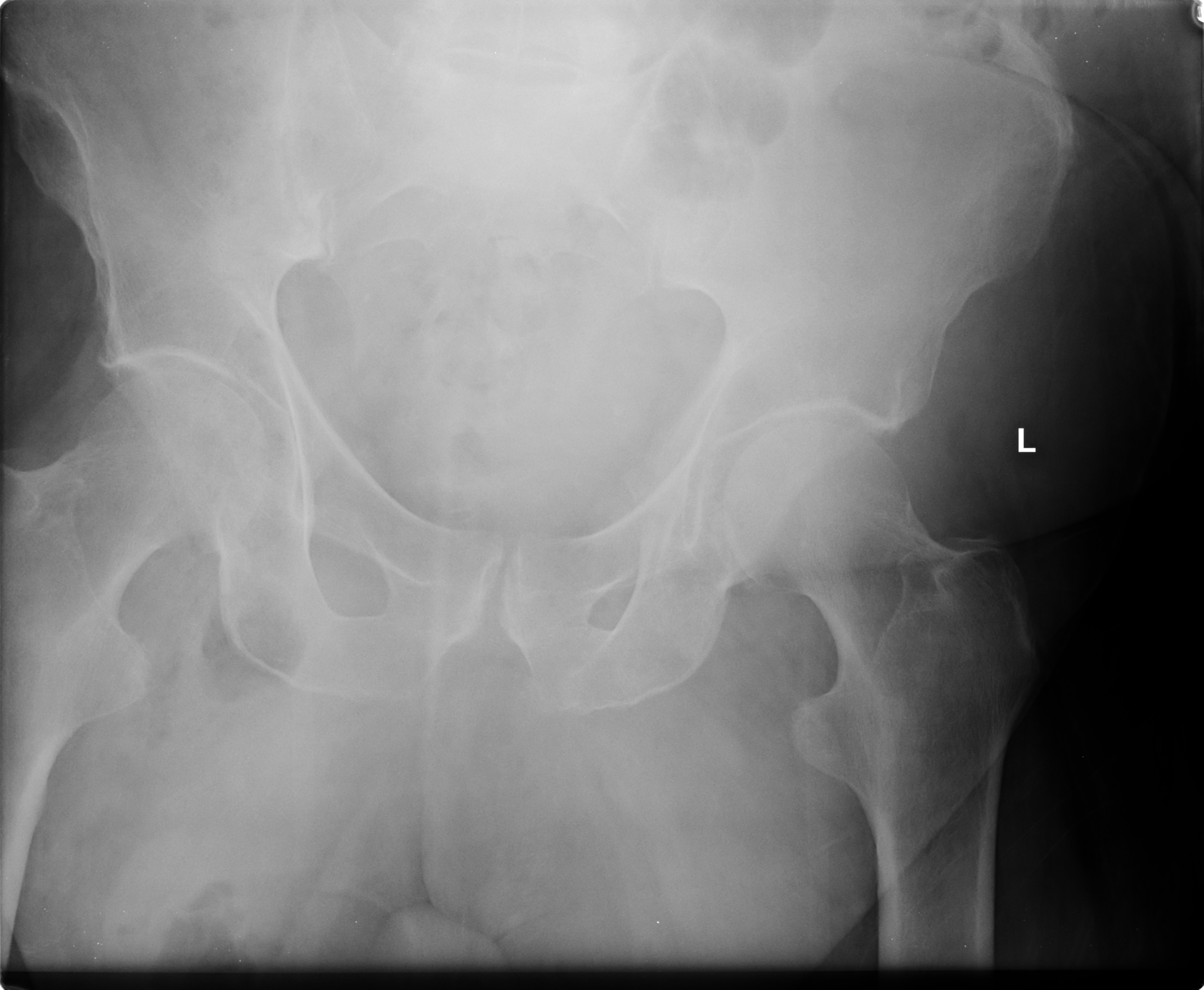 Large inguinal hernia | Image | Radiopaedia.org