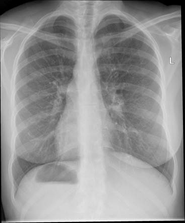 Kartagener syndrome | Radiology Case | Radiopaedia.org