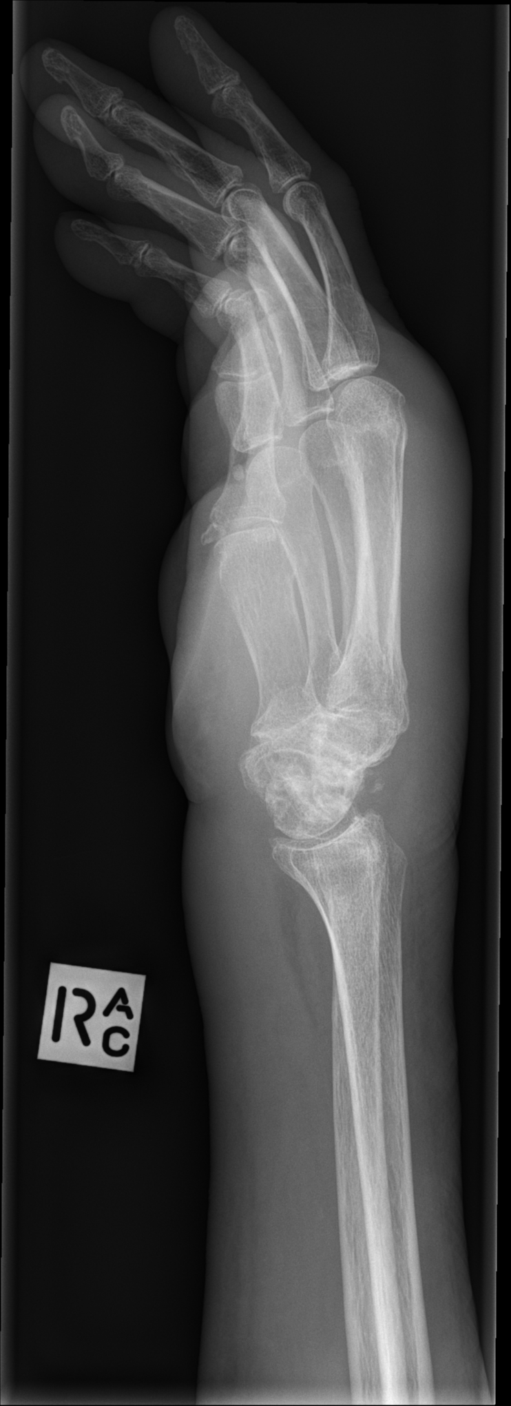 Right SLAC wrist | Image | Radiopaedia.org