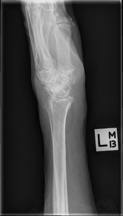 Right SLAC wrist | Image | Radiopaedia.org