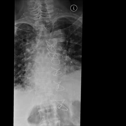 Gibbus deformity | Radiology Case | Radiopaedia.org