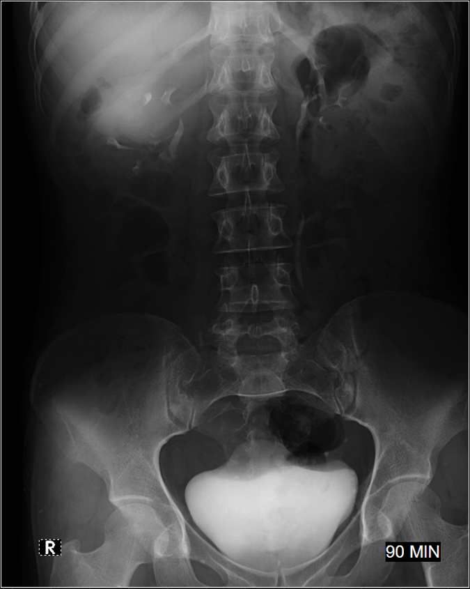 Calyceal diverticulum | Image | Radiopaedia.org