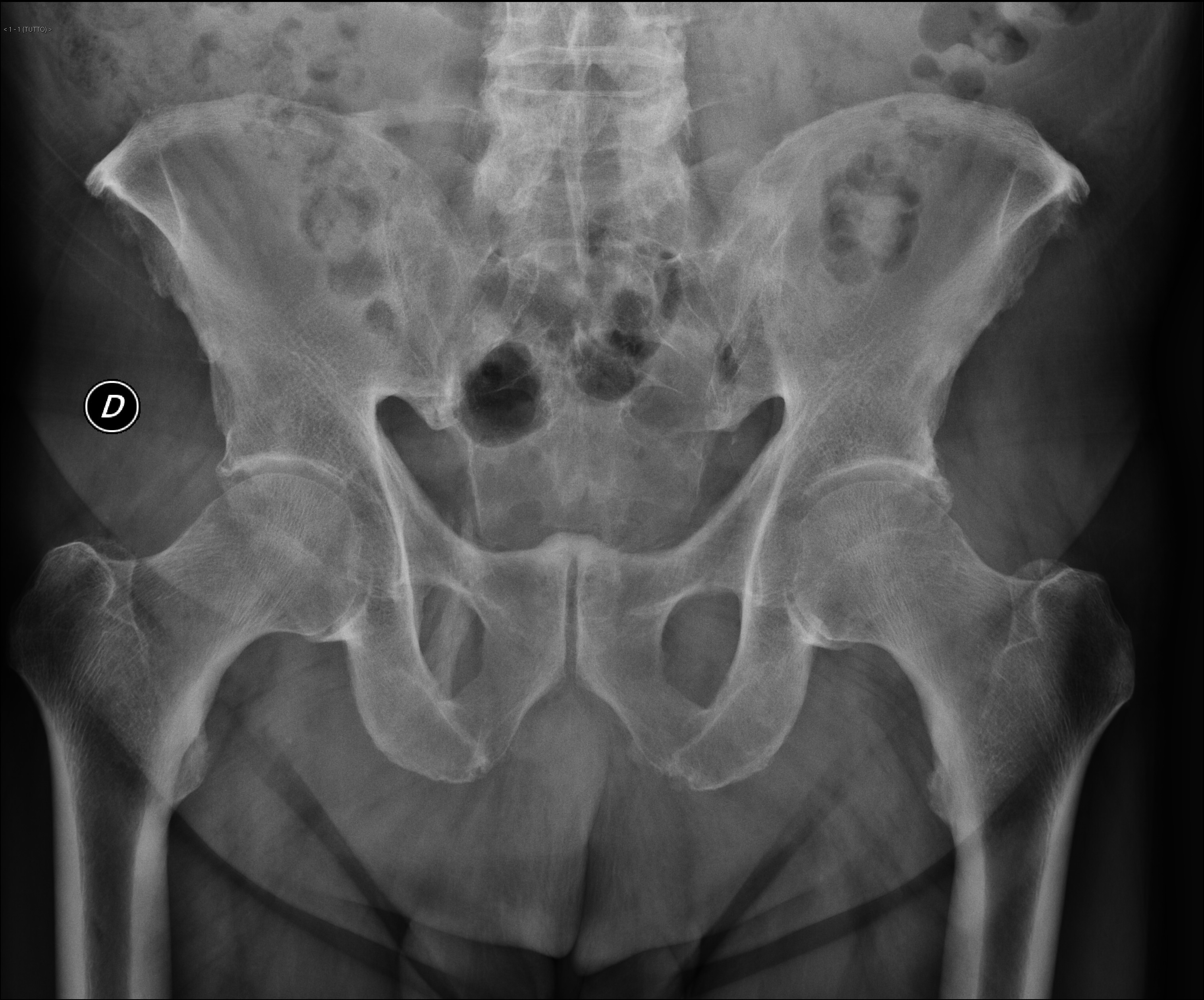 Sacrotuberous ligament ossification | Image | Radiopaedia.org