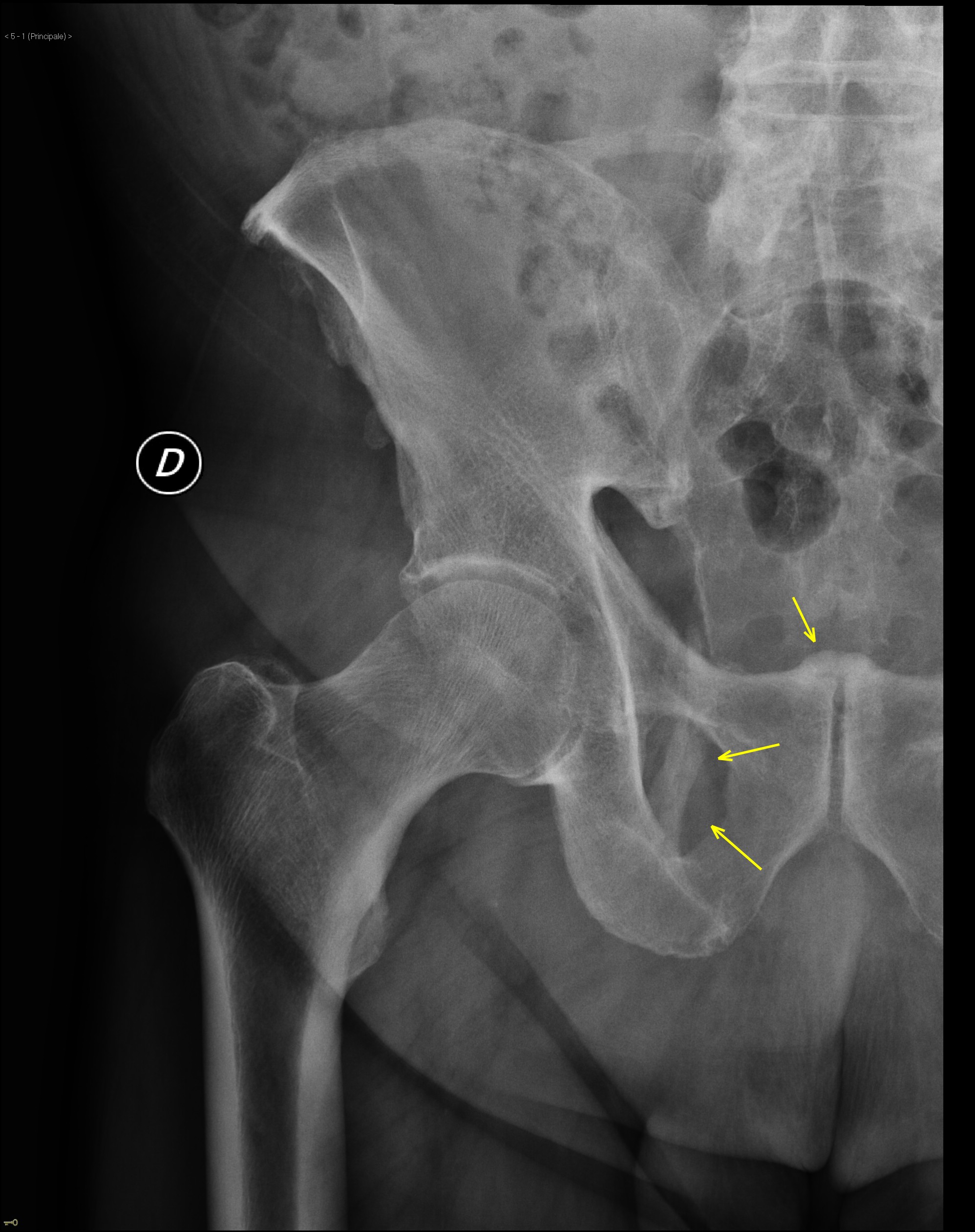 Sacrotuberous ligament ossification | Image | Radiopaedia.org