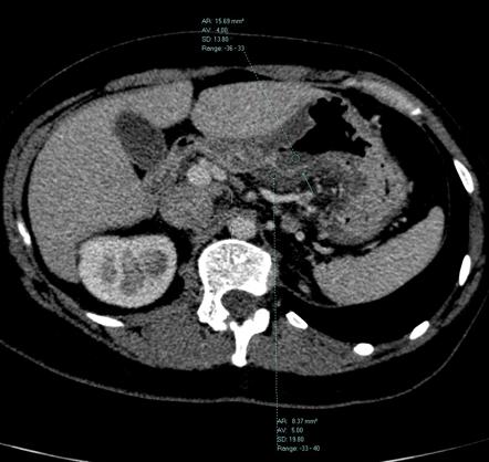 Acute gastritis | Image | Radiopaedia.org