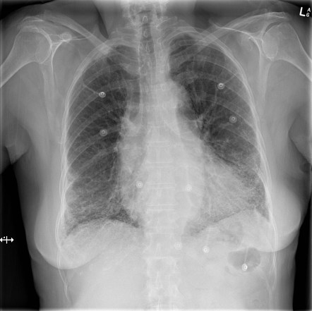 Giant cell interstitial pneumonia | Radiology Case | Radiopaedia.org