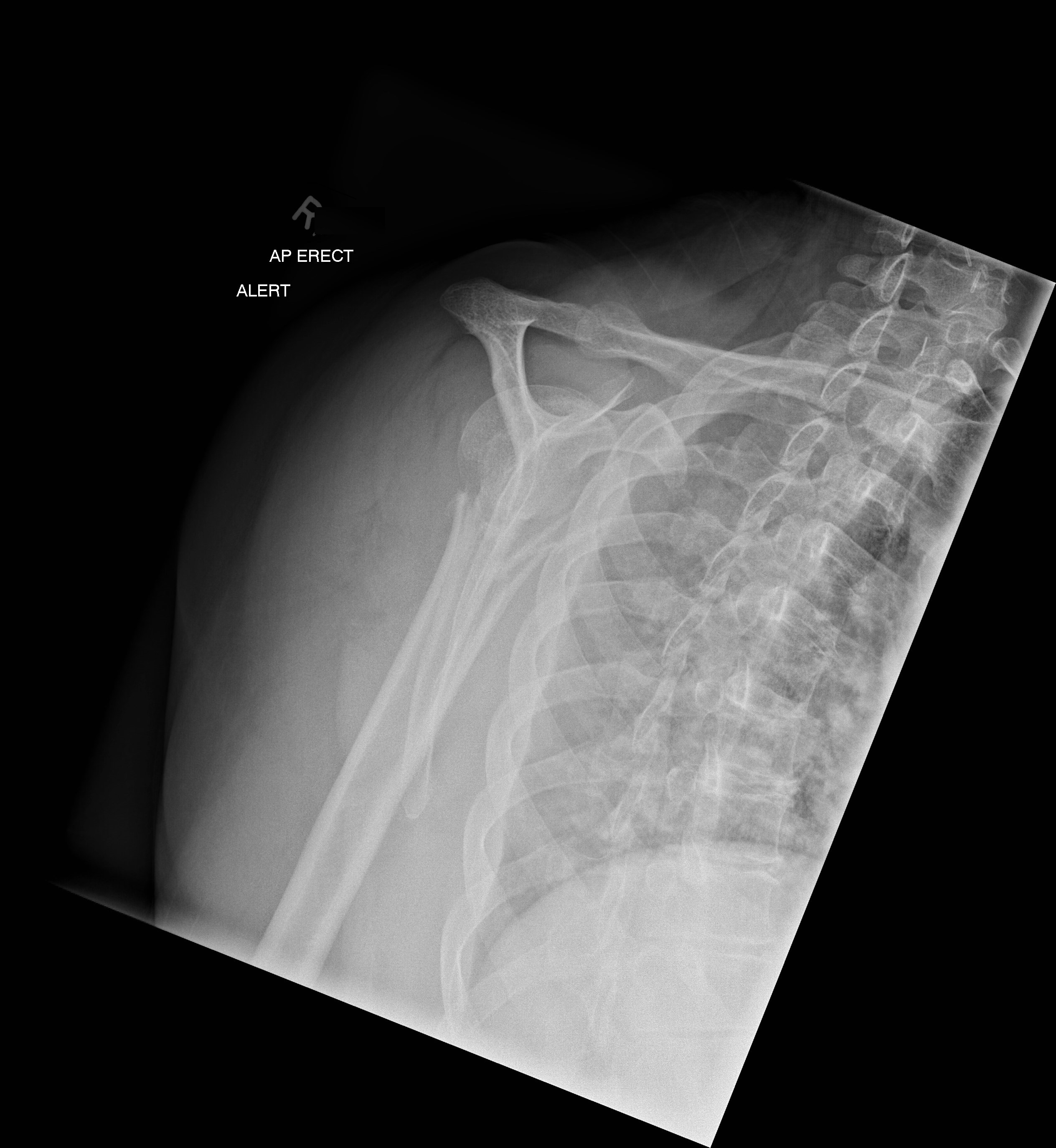 X Ray Shoulder Anatomy