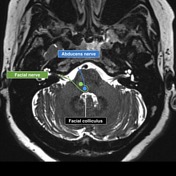 5th of facial nerve mri