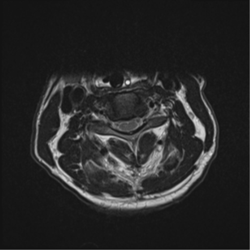 Cavernoma of cervical cord | Image | Radiopaedia.org