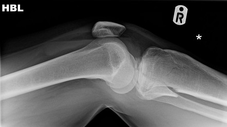 Tibial plateau fracture | Radiology Case | Radiopaedia.org