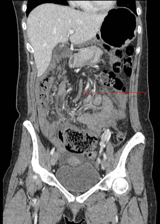 Strangulated Transmesenteric Small Bowel Internal Hernia Image 3205