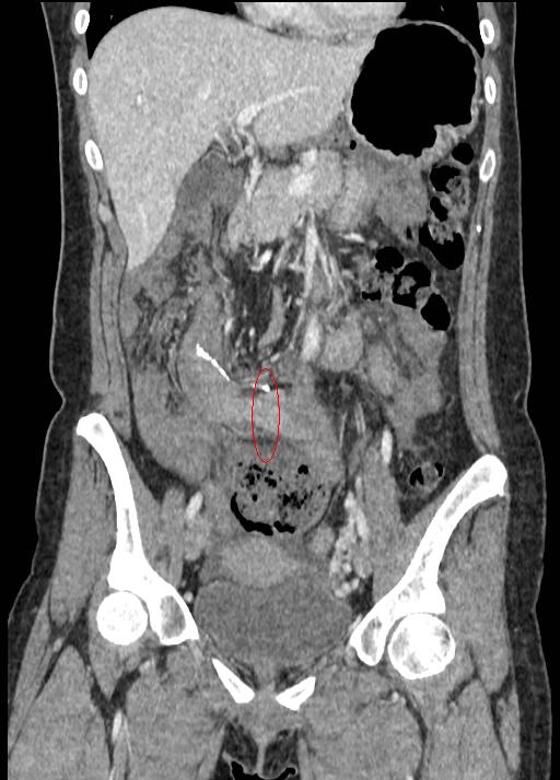 Strangulated Transmesenteric Small Bowel Internal Hernia Image 2649