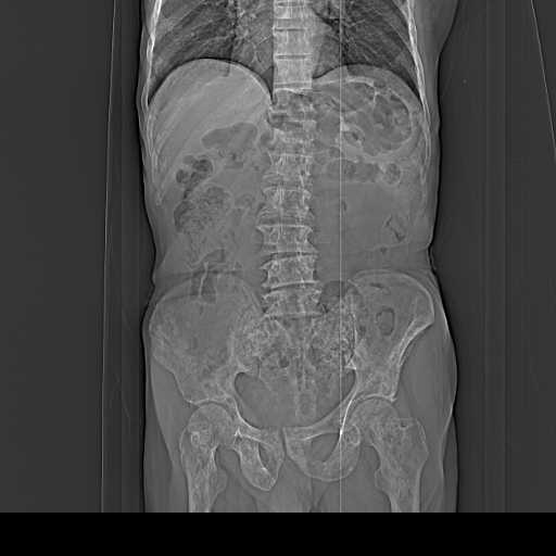 diffuse-osteoblastic-bone-metastases-prostate-cancer-image