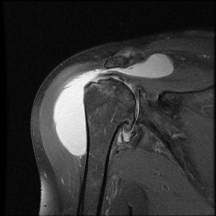 Subdeltoid Bursitis Mri