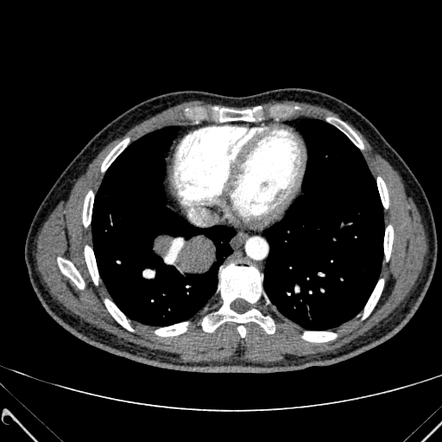 Scimitar syndrome (lungs) | Radiology Reference Article | Radiopaedia.org