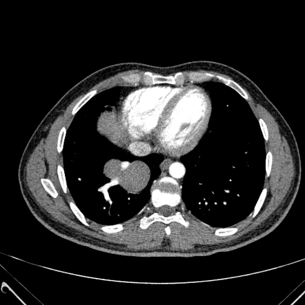 Scimitar syndrome | Radiology Case | Radiopaedia.org