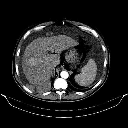 Peritoneal metastases | Radiology Reference Article | Radiopaedia.org