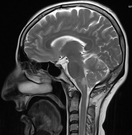 Posterior inferior cerebellar artery infarct | Radiology Case ...