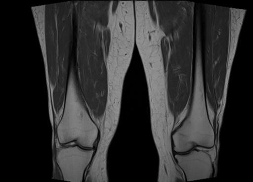 Polymyositis | Image | Radiopaedia.org