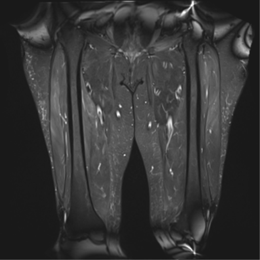 Polymyositis | Image | Radiopaedia.org