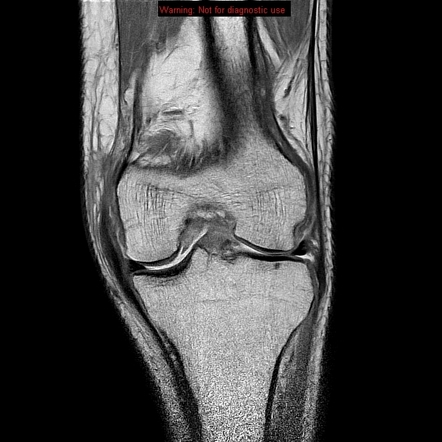 Segond Fracture With Associated Anterior Cruciate Ligament Tear 