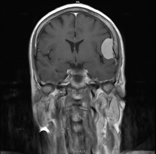 Meningioma | Radiology Reference Article | Radiopaedia.org