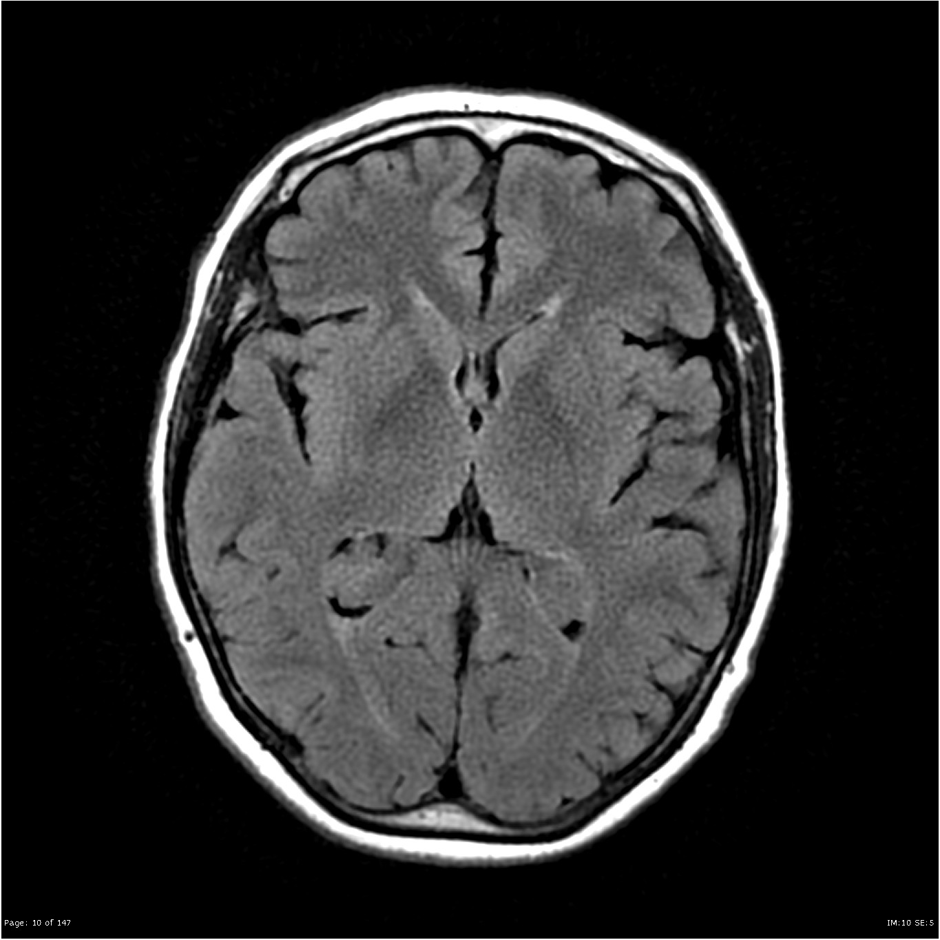 normal-mri-brain-scan