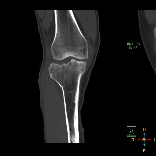 Tibial plateau fracture: Schatzker type V | Image | Radiopaedia.org