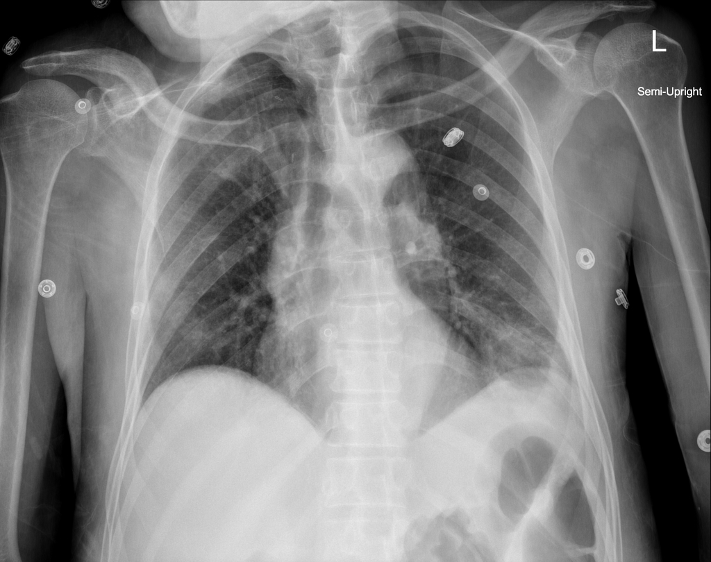 ir drainage of abscess