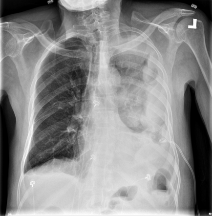 Empyema as a complication of percutaneous lung abscess drainage ...